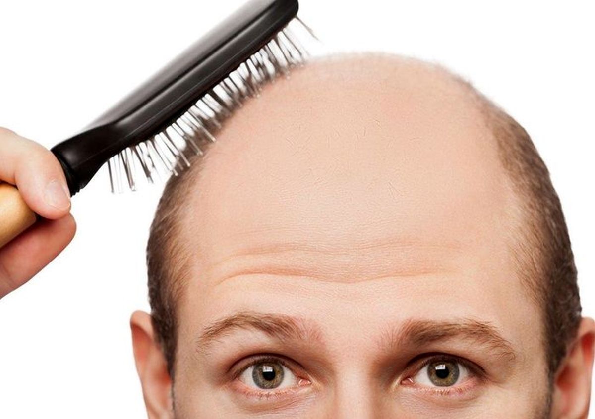 جلوگیری ریزش موی آقایان با پنج روش آسان